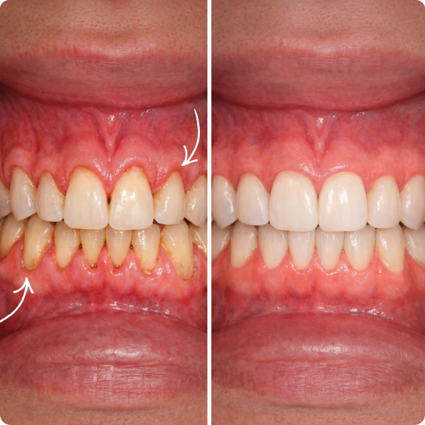 VeroCore™ Oral Defence Supplements for Gums Receding