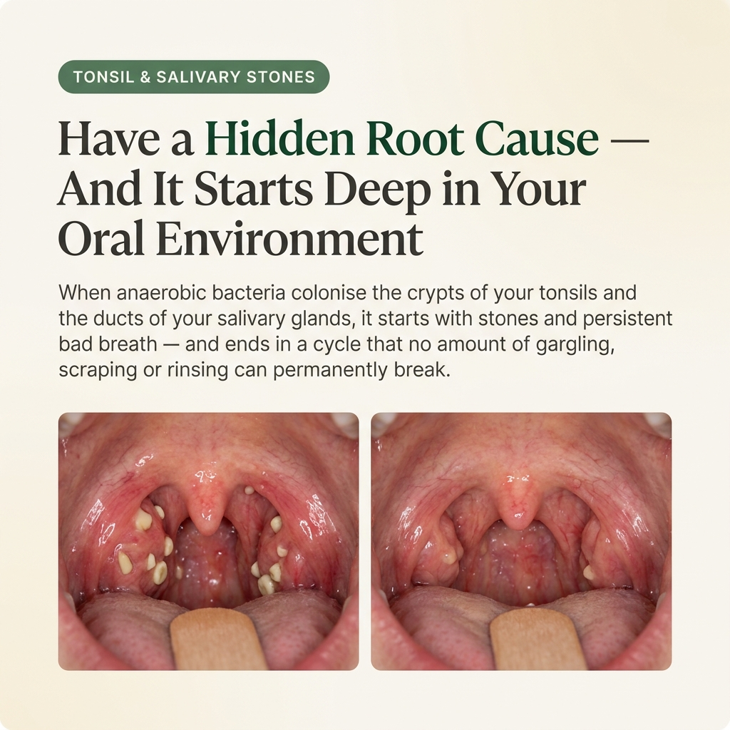 VeroCare™ Oral Defence Lozenges for Tonsil & Salivary Stones